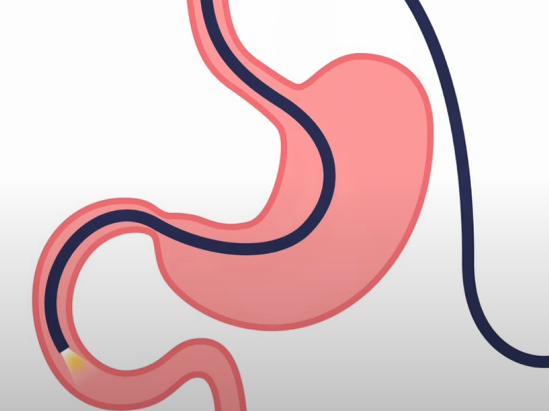 Превью видео: гастроскопия